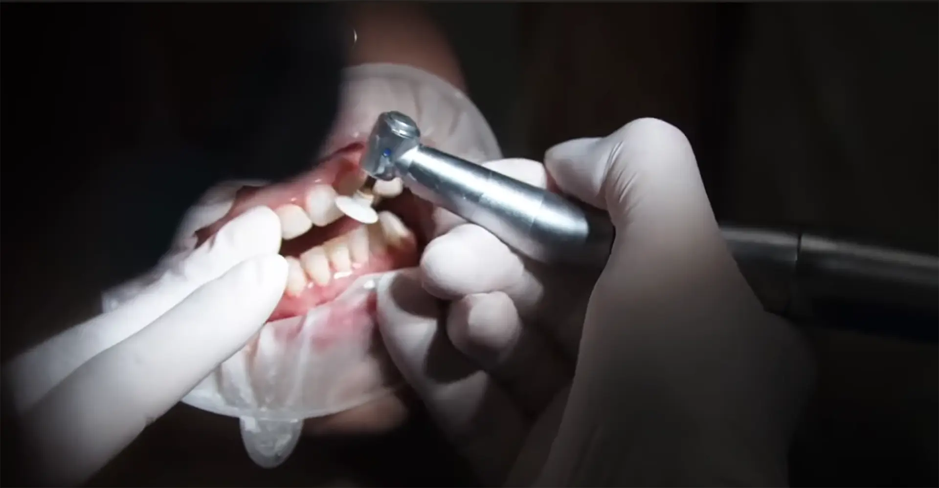 Dental Bonding In Atlanta Hero